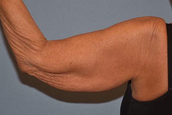 Arm Lift Before & After Gallery - Patient 238284 - Image 5
