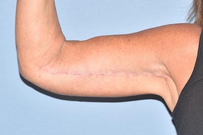 Arm Lift Before & After Gallery - Patient 238284 - Image 8