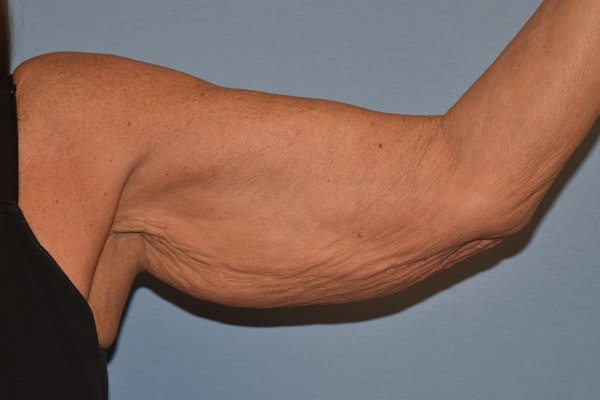 Arm Lift Before & After Gallery - Patient 238284 - Image 3