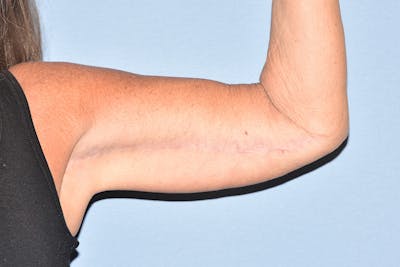 Arm Lift Before & After Gallery - Patient 238284 - Image 4