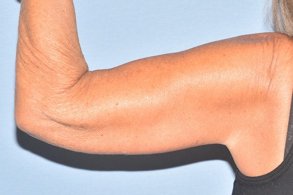 Arm Lift Before & After Gallery - Patient 238284 - Image 6