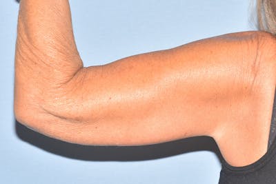 Arm Lift Before & After Gallery - Patient 238284 - Image 6