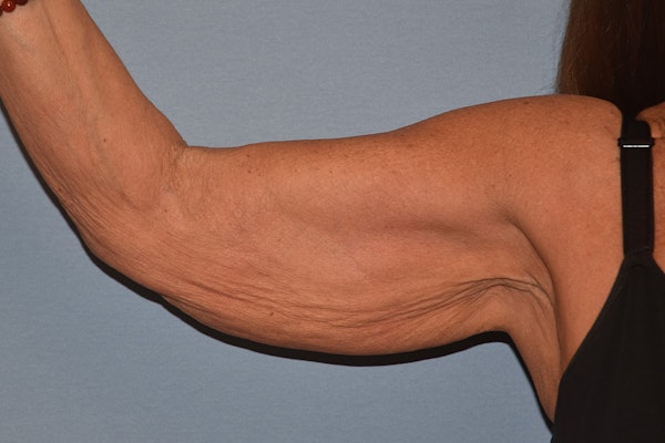 Arm Lift Before & After Gallery - Patient 238284 - Image 7