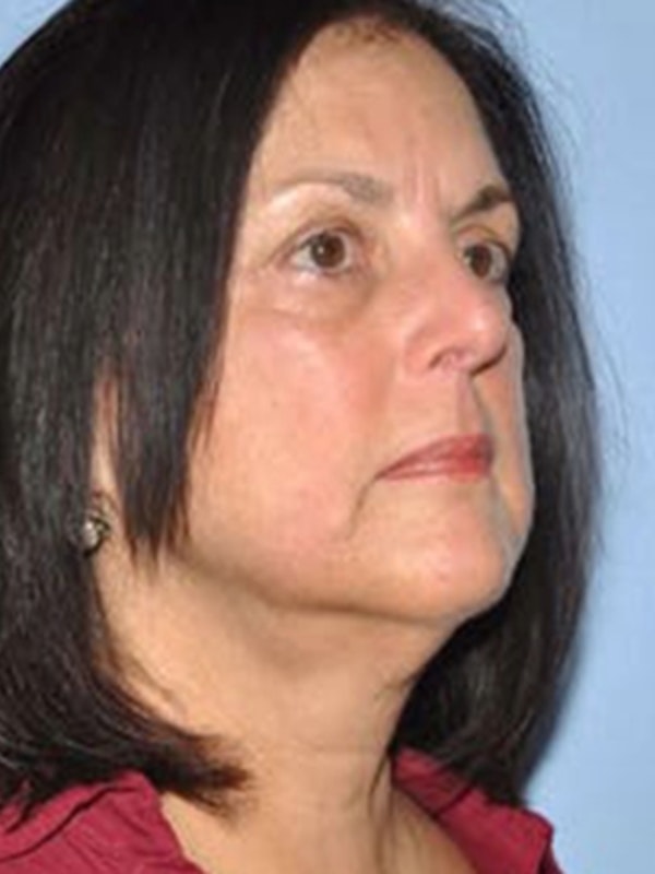 Facelift - Dr. James Romanelli