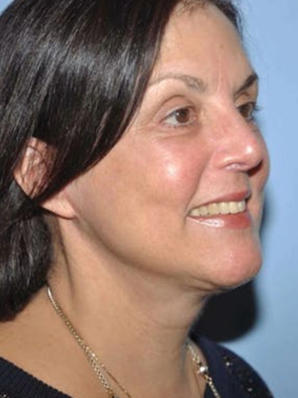 Facelift - Dr. James Romanelli