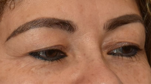 Blepharoplasty - Dr. Yee Cheng Low