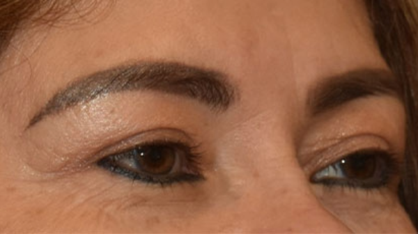 Blepharoplasty - Dr. Yee Cheng Low