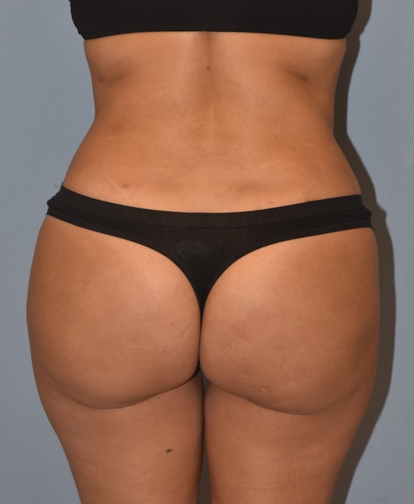 Brazilian Butt Lift Before & After Gallery - Patient 396208 - Image 2