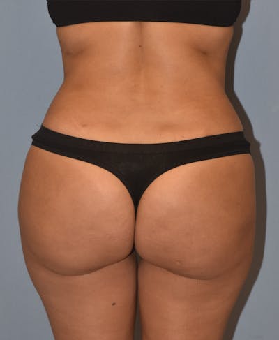 Brazilian Butt Lift Before & After Gallery - Patient 396208 - Image 2