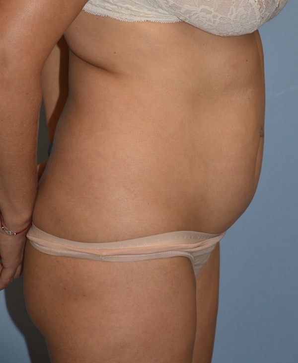 Brazilian Butt Lift Before & After Gallery - Patient 396208 - Image 5