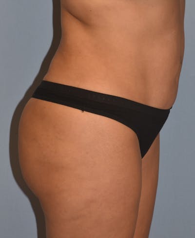 Brazilian Butt Lift Before & After Gallery - Patient 396208 - Image 6