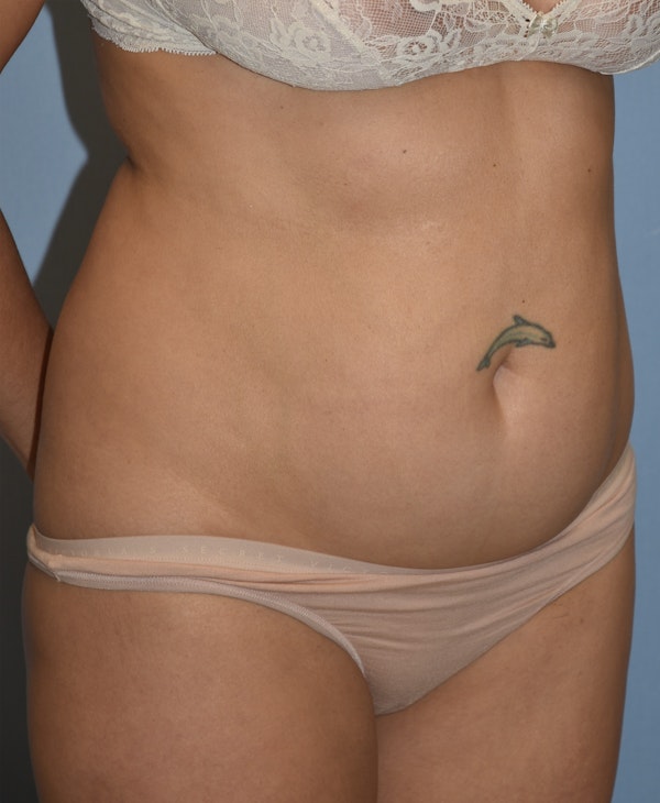 Brazilian Butt Lift Before & After Gallery - Patient 396208 - Image 7