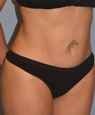 Brazilian Butt Lift Before & After Gallery - Patient 396208 - Image 8