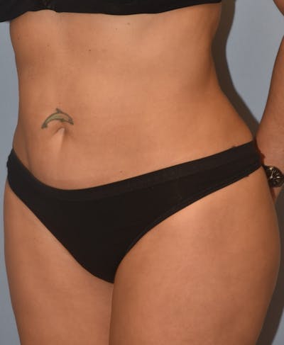 Brazilian Butt Lift Before & After Gallery - Patient 396208 - Image 10