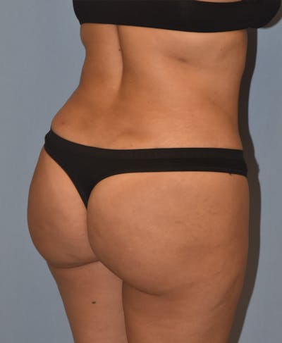 Brazilian Butt Lift Before & After Gallery - Patient 396208 - Image 4
