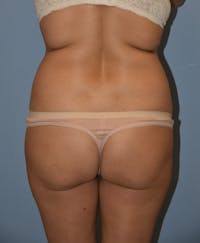 Brazilian Butt Lift Before & After Gallery - Patient 396208 - Image 1