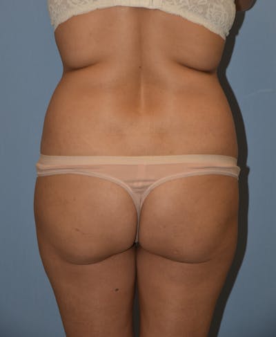 Brazilian Butt Lift Before & After Gallery - Patient 396208 - Image 1