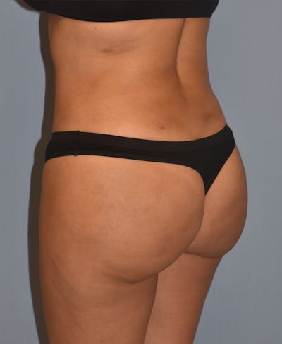 Brazilian Butt Lift Before & After Gallery - Patient 396208 - Image 12
