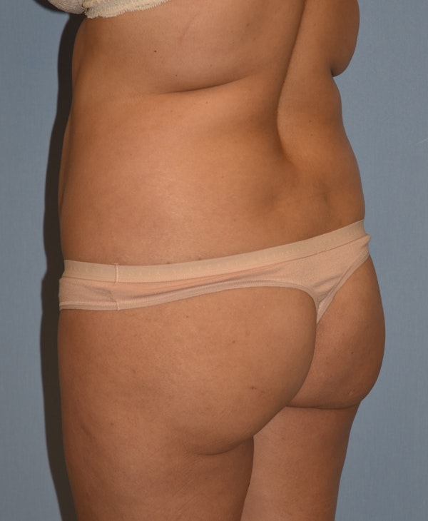 Brazilian Butt Lift Before & After Gallery - Patient 396208 - Image 11