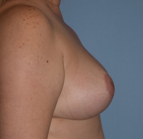 Breast Reduction Before & After Gallery - Patient 316747 - Image 4