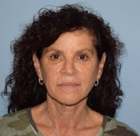 Facelift Before & After Gallery - Patient 332533 - Image 1