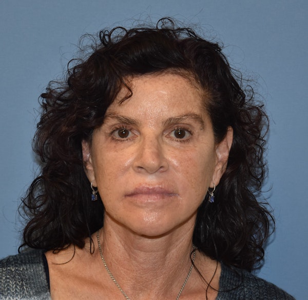 Facelift Before & After Gallery - Patient 332533 - Image 2