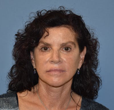Facelift Before & After Gallery - Patient 332533 - Image 2