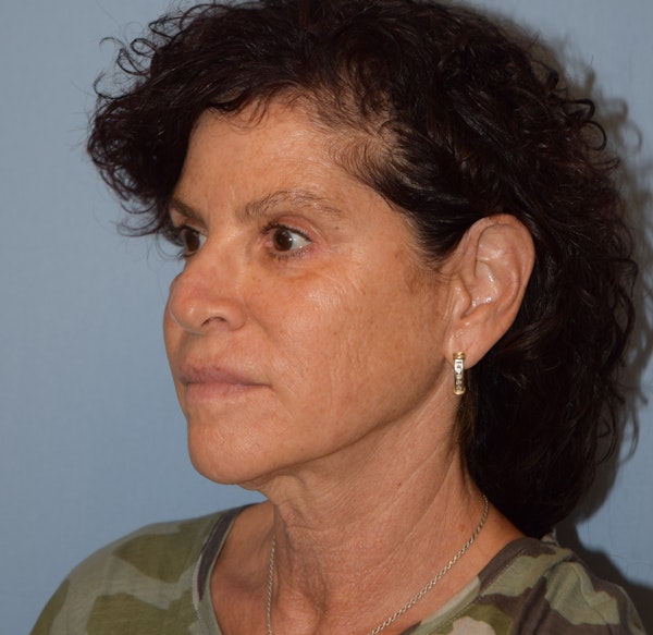 Facelift Before & After Gallery - Patient 332533 - Image 3