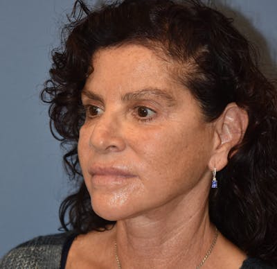 Facelift Before & After Gallery - Patient 332533 - Image 4