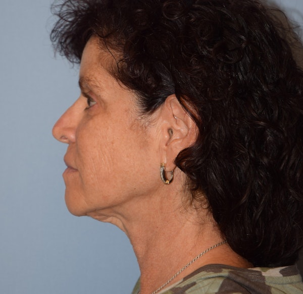 Facelift Before & After Gallery - Patient 332533 - Image 5