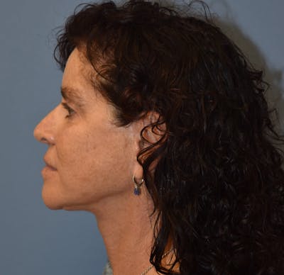 Facelift Before & After Gallery - Patient 332533 - Image 6