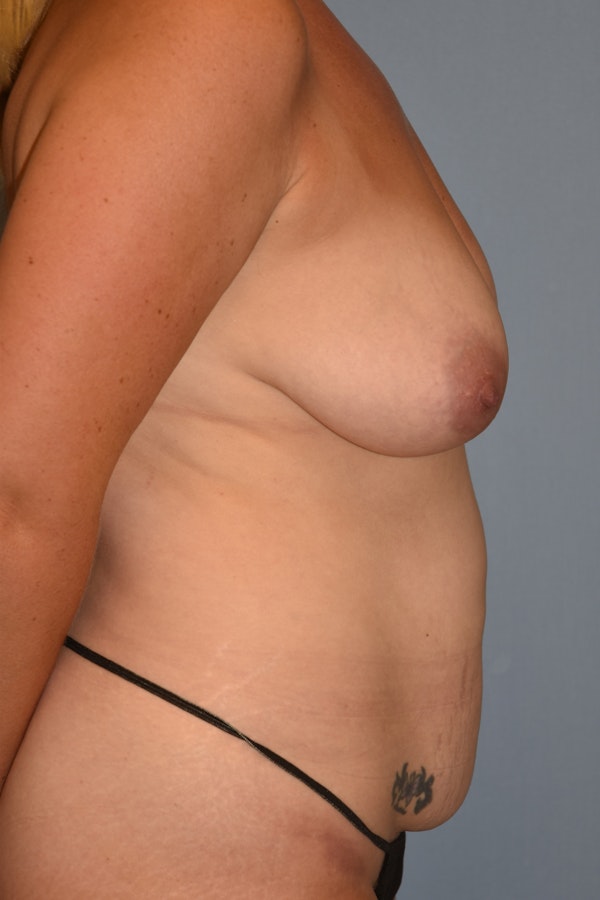 Mommy Makeover Before & After Gallery - Patient 429366 - Image 5