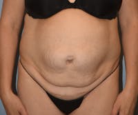 Tummy Tuck Before & After Gallery - Patient 233481 - Image 1