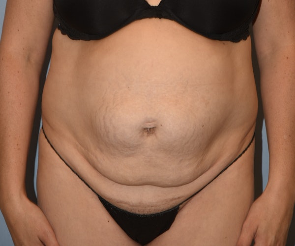 Tummy Tuck Before & After Gallery - Patient 233481 - Image 1