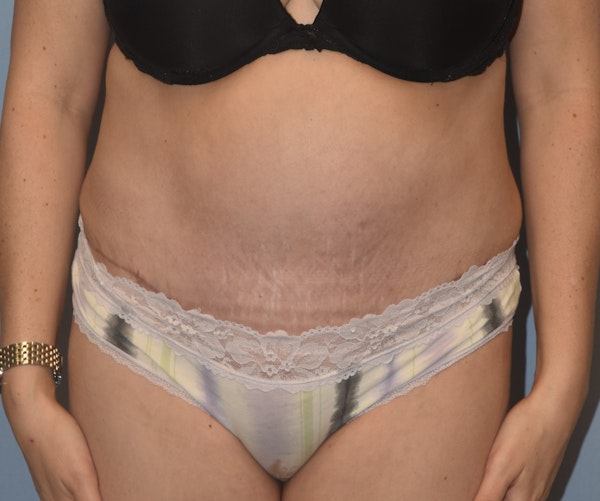 Tummy Tuck Before & After Gallery - Patient 233481 - Image 2