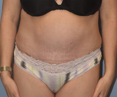 Tummy Tuck Before & After Gallery - Patient 233481 - Image 2