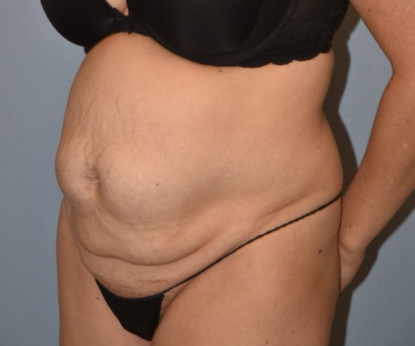 Tummy Tuck Before & After Gallery - Patient 233481 - Image 3