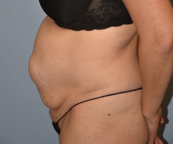 Tummy Tuck Before & After Gallery - Patient 233481 - Image 5