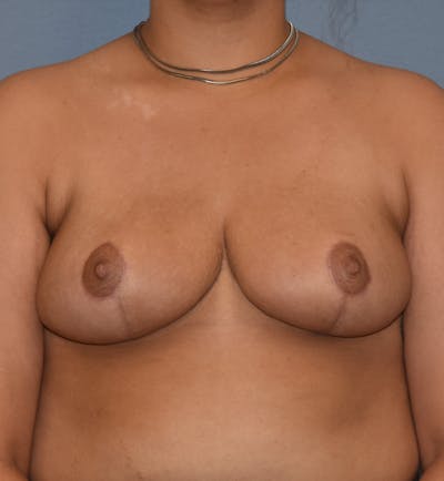 Breast Reduction Before & After Gallery - Patient 196126 - Image 2