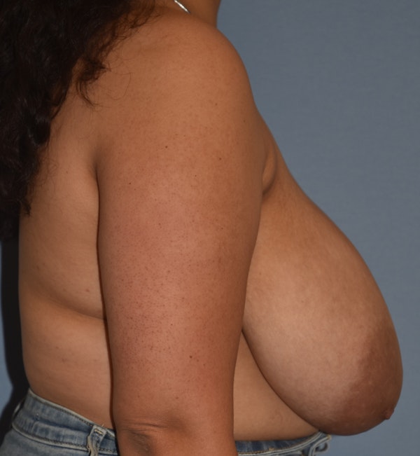 Breast Reduction Before & After Gallery - Patient 196126 - Image 5