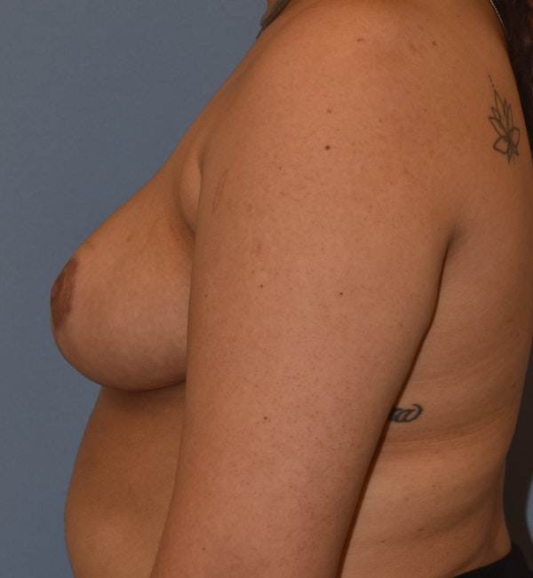 Breast Reduction Before & After Gallery - Patient 196126 - Image 10