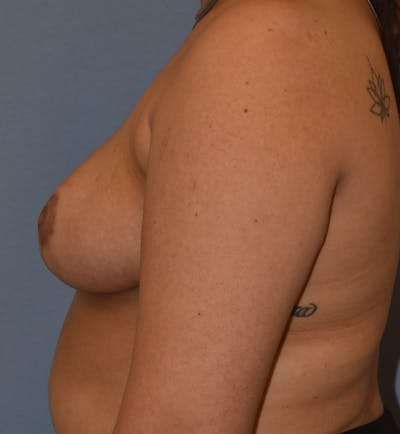 Breast Reduction Before & After Gallery - Patient 196126 - Image 10