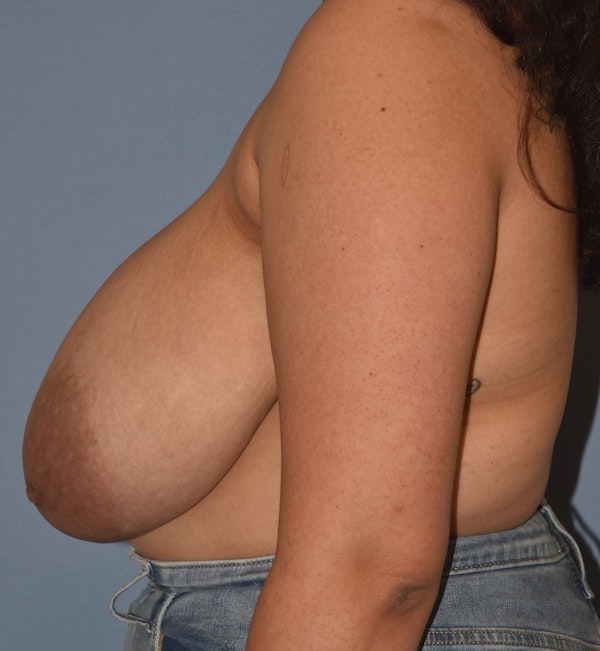 Breast Reduction Before & After Gallery - Patient 196126 - Image 9