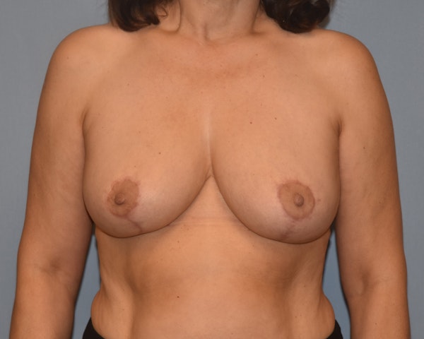 Breast Reduction Before & After Gallery - Patient 480288 - Image 2