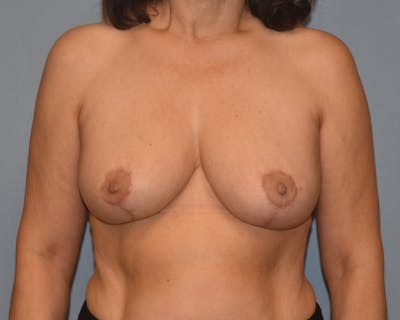 Breast Reduction Before & After Gallery - Patient 480288 - Image 2