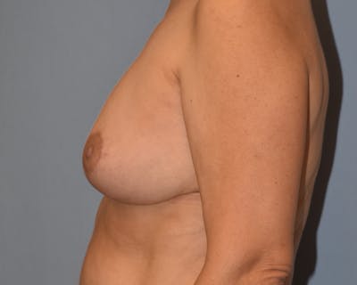 Breast Reduction Before & After Gallery - Patient 480288 - Image 6