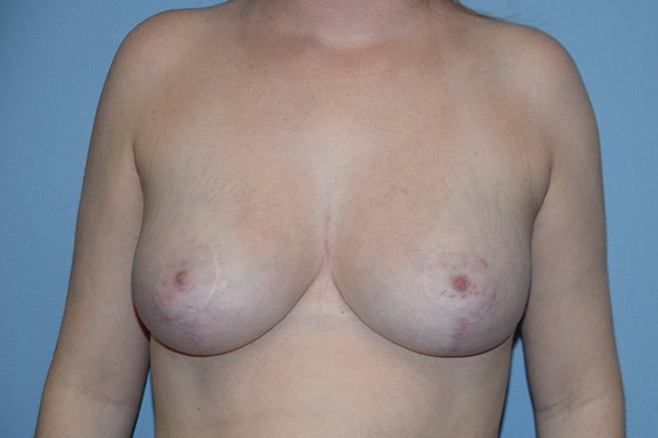 Breast Reduction Before & After Gallery - Patient 165460 - Image 2