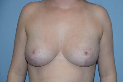 Breast Reduction Before & After Gallery - Patient 165460 - Image 2