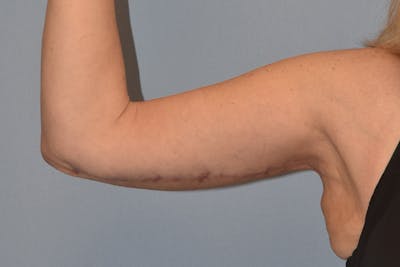 Arm Lift Before & After Gallery - Patient 822132 - Image 4