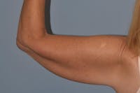 Arm Lift Before & After Gallery - Patient 822132 - Image 1